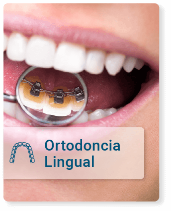Ortodoncia--lingual